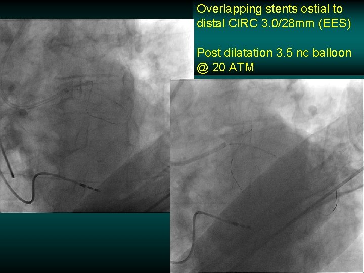 Overlapping stents ostial to distal CIRC 3. 0/28 mm (EES) Post dilatation 3. 5