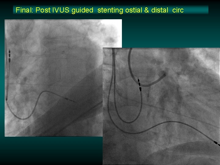 Final: Post IVUS guided stenting ostial & distal circ 