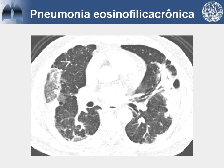 Pneumonia eosinofílicacrônica 