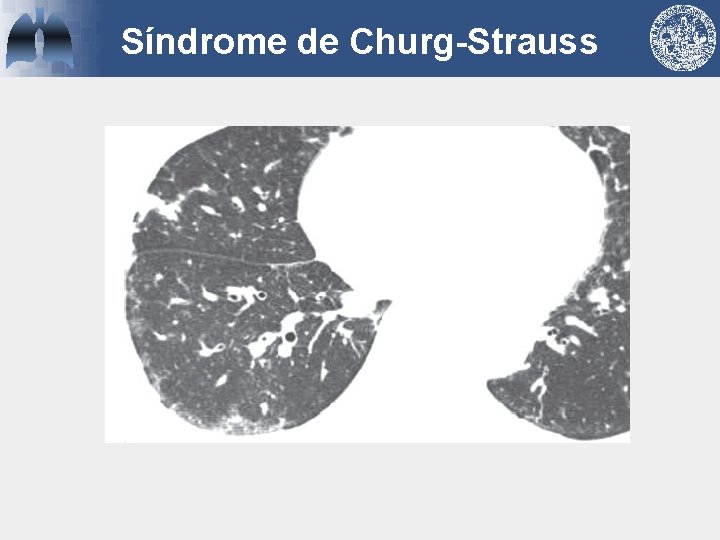 Síndrome de Churg-Strauss 