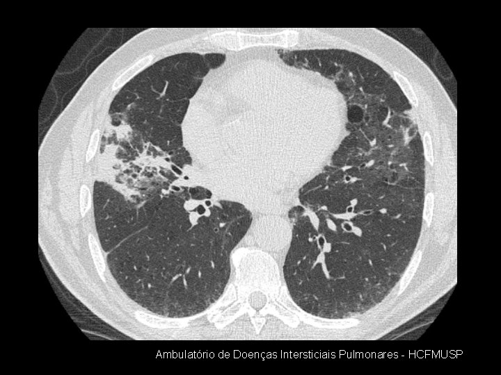 Ambulatório de Doenças Intersticiais Pulmonares - HCFMUSP 