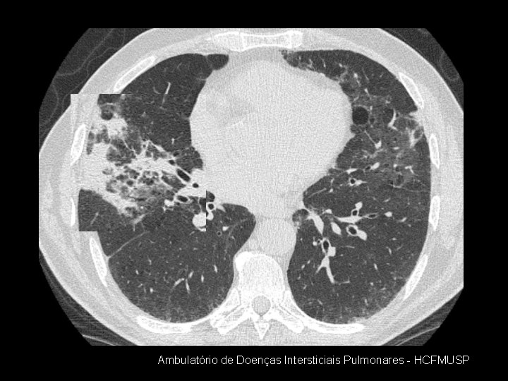 Ambulatório de Doenças Intersticiais Pulmonares - HCFMUSP 