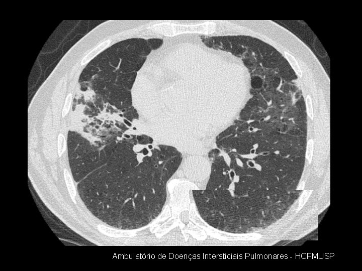 Ambulatório de Doenças Intersticiais Pulmonares - HCFMUSP 