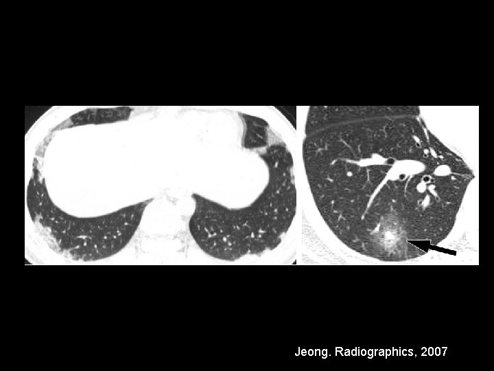 Jeong. Radiographics, 2007 