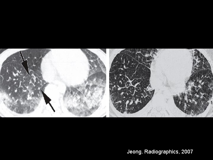 Jeong. Radiographics, 2007 