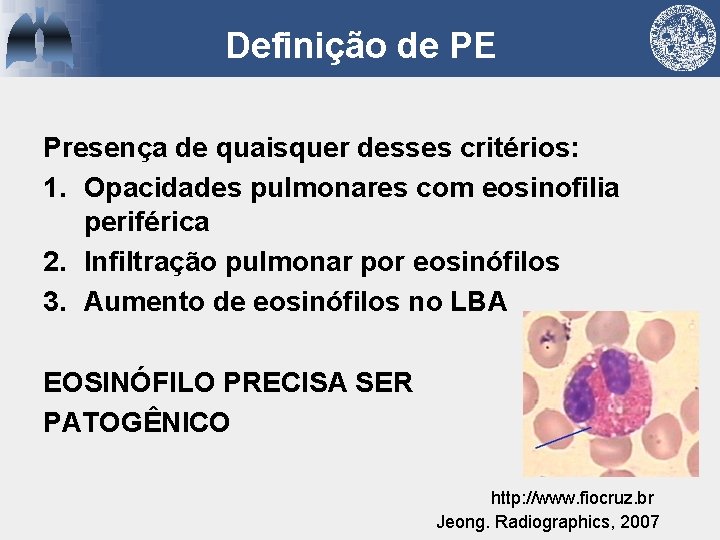 Definição de PE Presença de quaisquer desses critérios: 1. Opacidades pulmonares com eosinofilia periférica