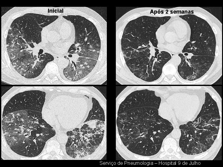 Inicial Após 2 semanas Serviço de Pneumologia – Hospital 9 de Julho 