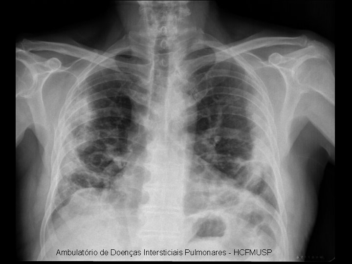 Ambulatório de Doenças Intersticiais Pulmonares - HCFMUSP 