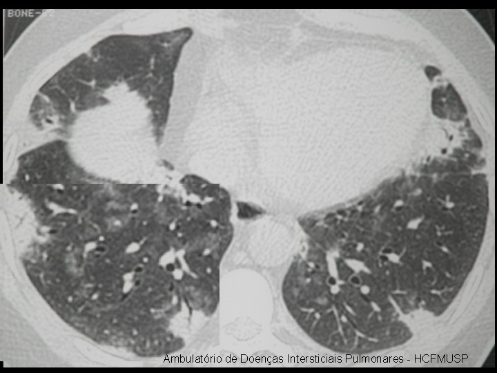 Ambulatório de Doenças Intersticiais Pulmonares - HCFMUSP 