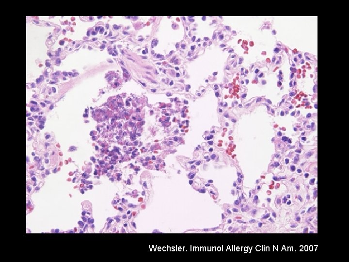 Wechsler. Immunol Allergy Clin N Am, 2007 