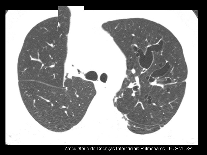 Ambulatório de Doenças Intersticiais Pulmonares - HCFMUSP 