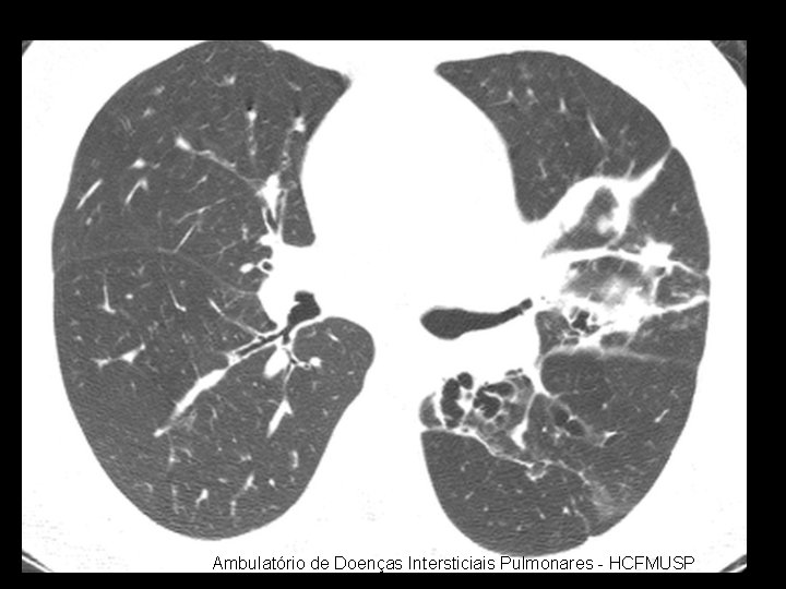 Ambulatório de Doenças Intersticiais Pulmonares - HCFMUSP 