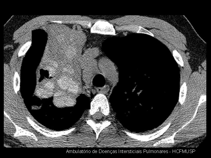 Ambulatório de Doenças Intersticiais Pulmonares - HCFMUSP 