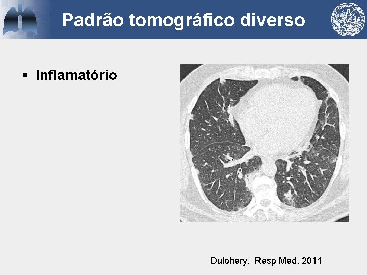 Padrão tomográfico diverso § Inflamatório Dulohery. Resp Med, 2011 