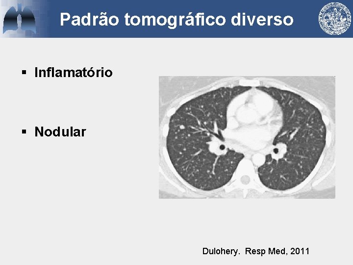 Padrão tomográfico diverso § Inflamatório § Nodular Dulohery. Resp Med, 2011 
