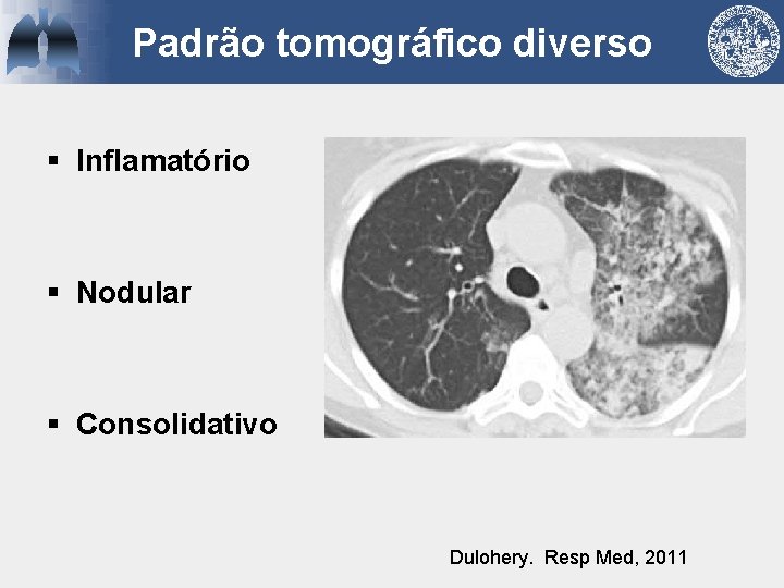 Padrão tomográfico diverso § Inflamatório § Nodular § Consolidativo Dulohery. Resp Med, 2011 