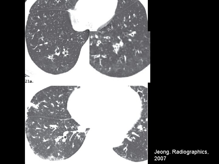 Jeong. Radiographics, 2007 