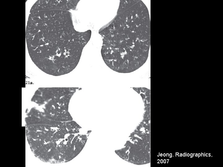 Jeong. Radiographics, 2007 