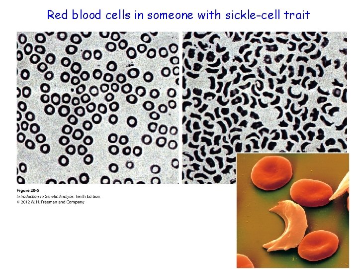 Red blood cells in someone with sickle-cell trait 