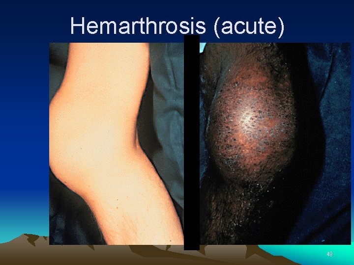 Hemarthrosis (acute) 49 