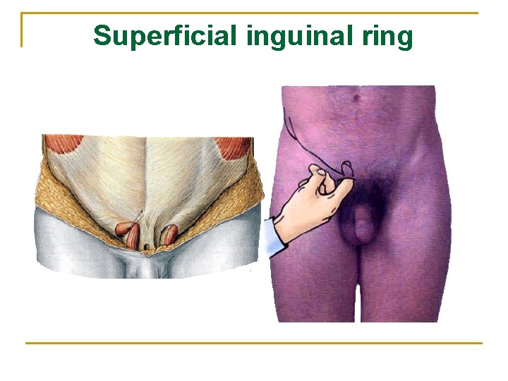 Superficial inguinal ring 