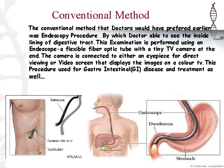 Conventional Method The conventional method that Doctors would have prefered earlier was Endoscopy Procedure.