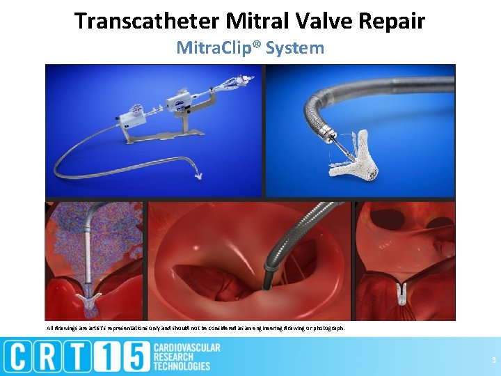 Transcatheter Mitral Valve Repair Mitra. Clip® System All drawings are artist's representations only and