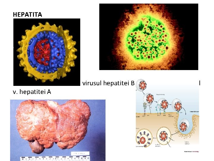 HEPATITA v. hepatitei A virusul hepatitei B virusul 