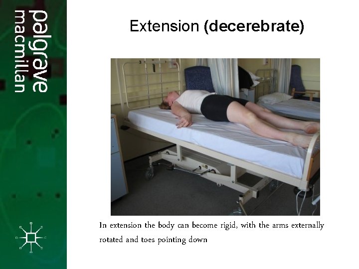 Extension (decerebrate) In extension the body can become rigid, with the arms externally rotated