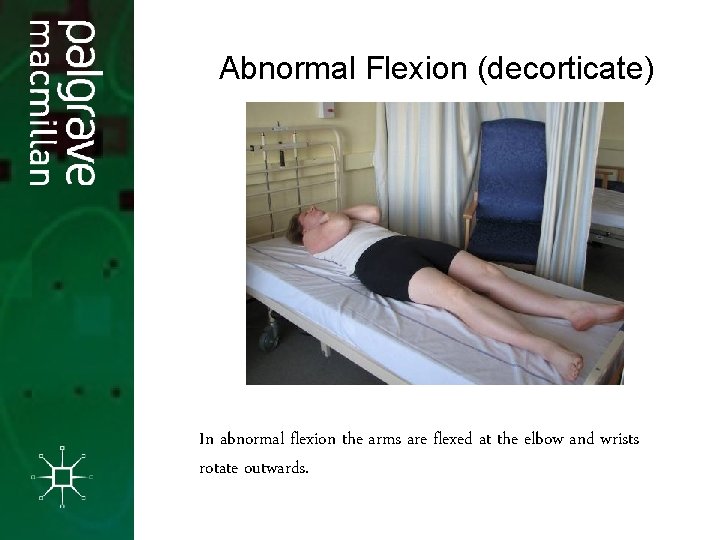 Abnormal Flexion (decorticate) In abnormal flexion the arms are flexed at the elbow and