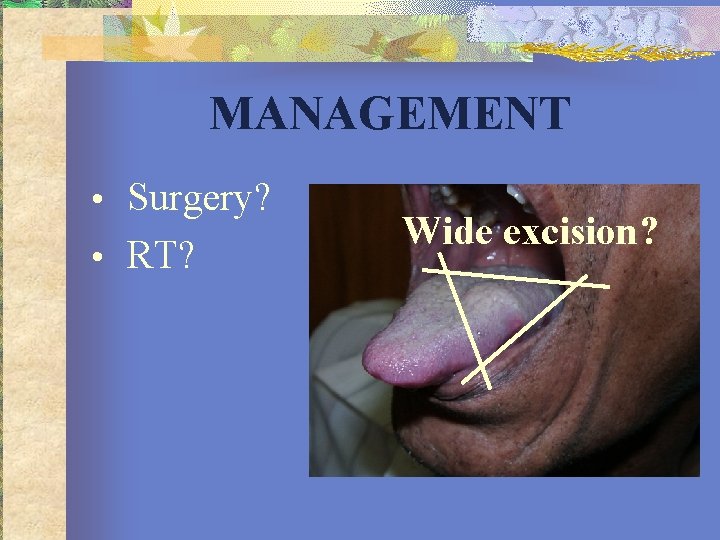 MANAGEMENT • Surgery? • RT? Wide excision? 