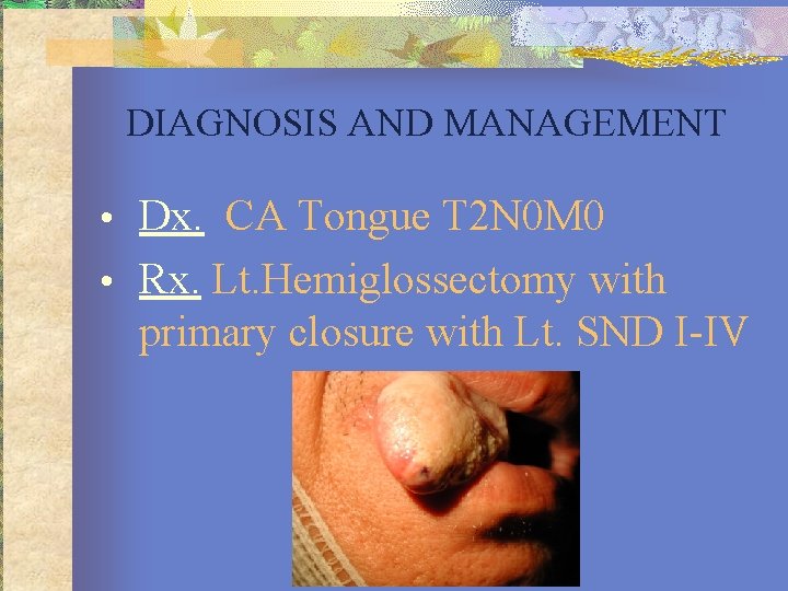 DIAGNOSIS AND MANAGEMENT • Dx. CA Tongue T 2 N 0 M 0 •