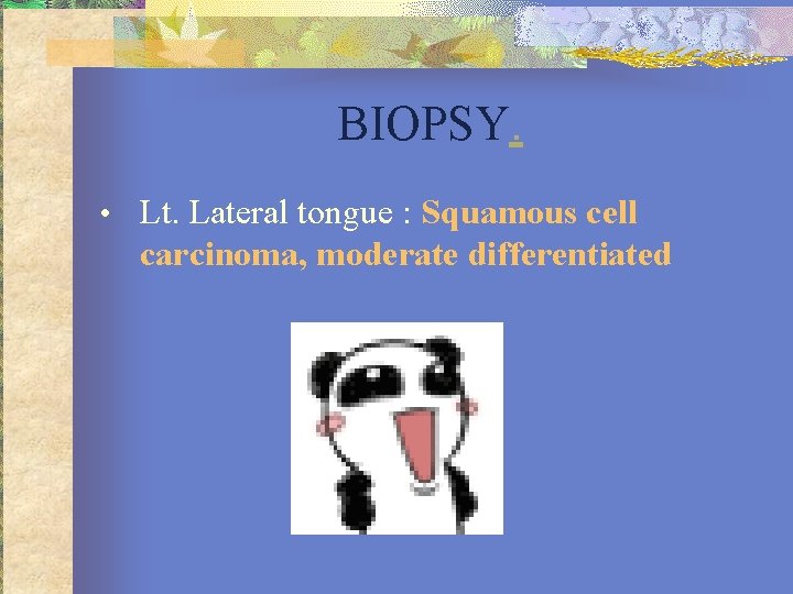 BIOPSY. • Lt. Lateral tongue : Squamous cell carcinoma, moderate differentiated 