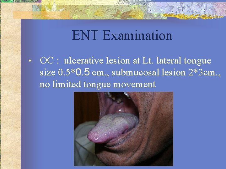 ENT Examination • OC : ulcerative lesion at Lt. lateral tongue size 0. 5*0.