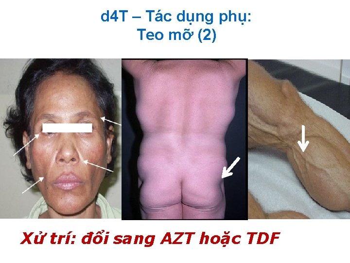 d 4 T – Tác dụng phụ: Teo mỡ (2) Xử trí: đổi sang