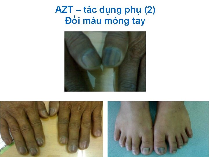 AZT – tác dụng phụ (2) Đổi màu móng tay 