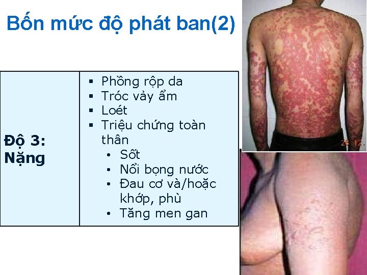 Bốn mức độ phát ban(2) Độ 3: Nặng § § Phồng rộp da Tróc