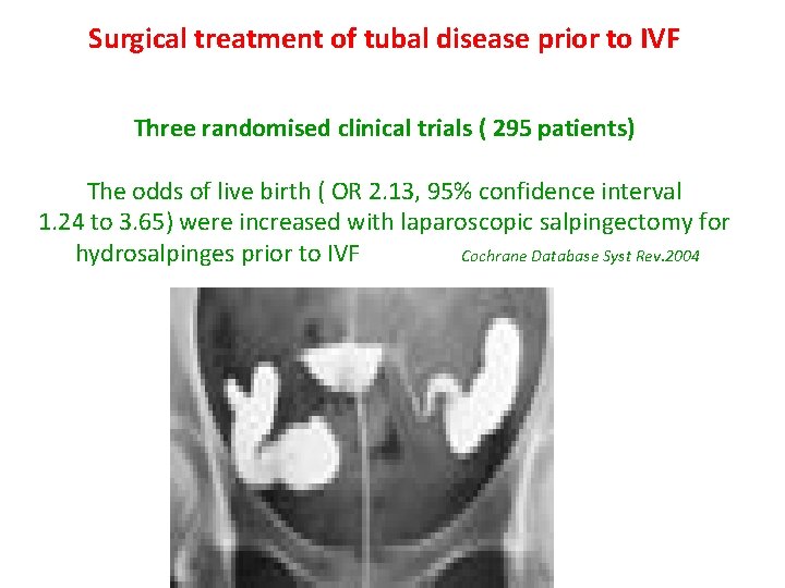 Surgical treatment of tubal disease prior to IVF Three randomised clinical trials ( 295