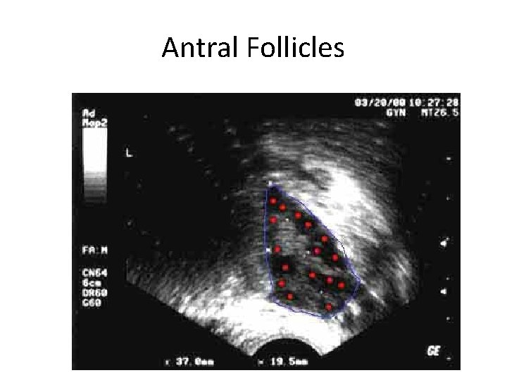 Antral Follicles 