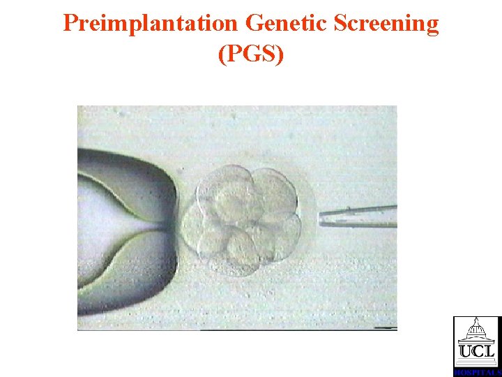 Preimplantation Genetic Screening (PGS) 