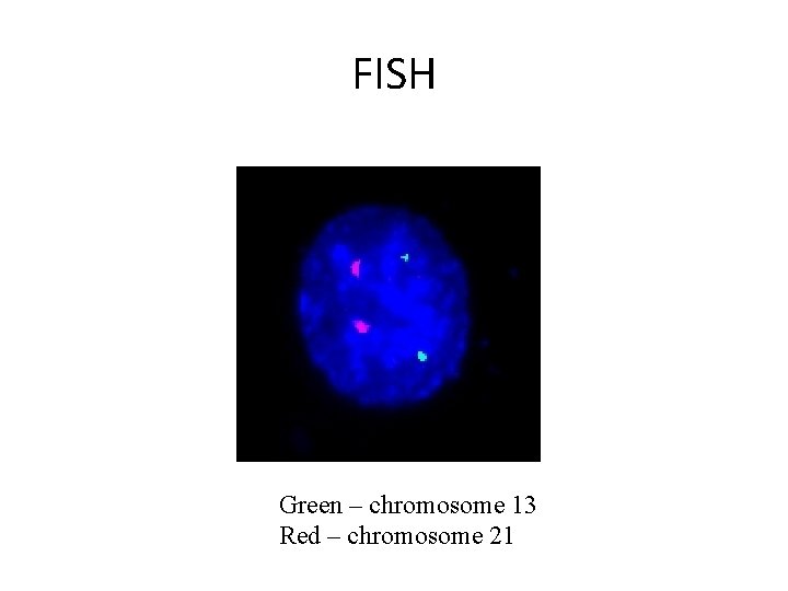 FISH Green – chromosome 13 Red – chromosome 21 
