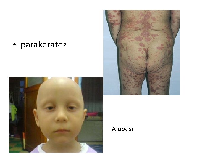  • parakeratoz Alopesi 