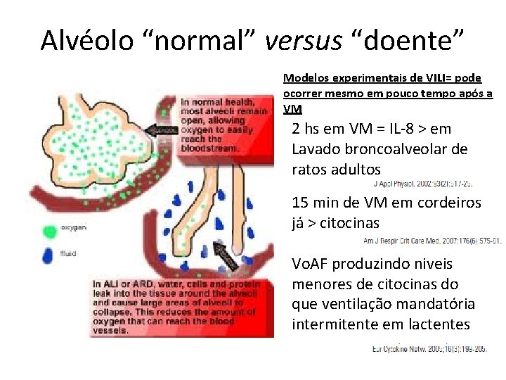 Alvéolo “normal” versus “doente” Modelos experimentais de VILI= pode ocorrer mesmo em pouco tempo