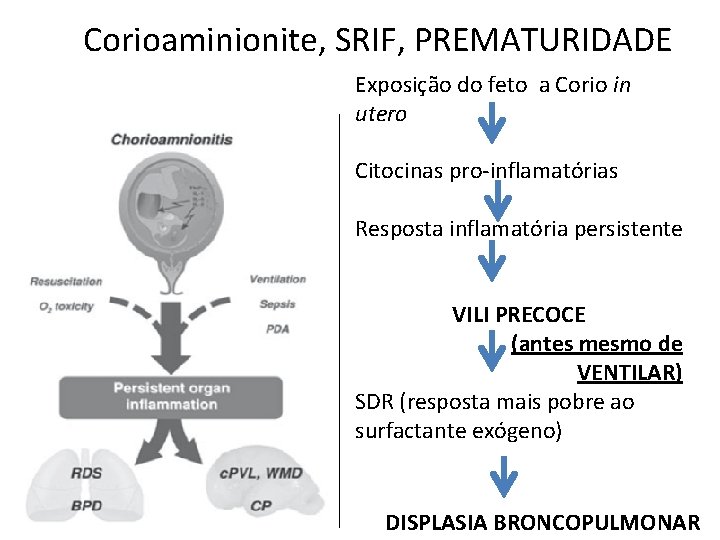 Corioaminionite, SRIF, PREMATURIDADE Exposição do feto a Corio in utero Citocinas pro-inflamatórias Resposta inflamatória