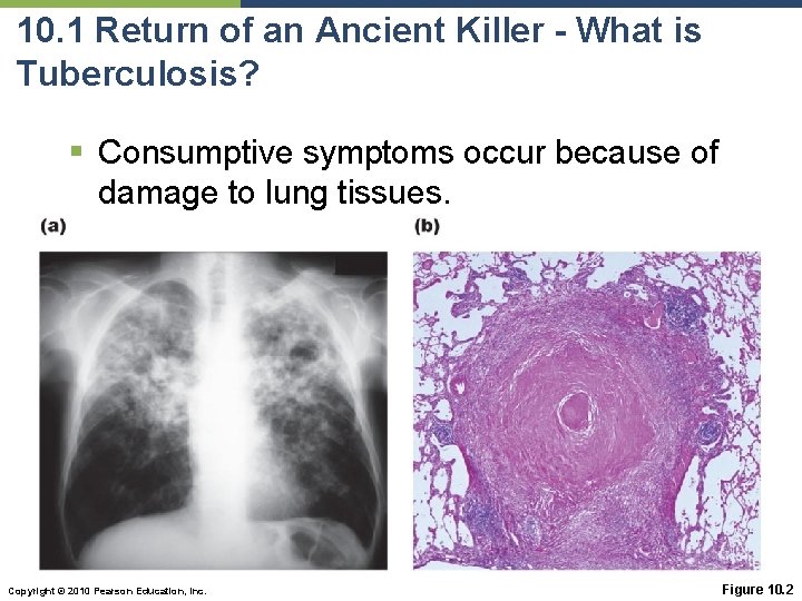 10. 1 Return of an Ancient Killer - What is Tuberculosis? § Consumptive symptoms