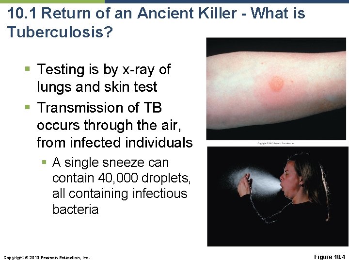 10. 1 Return of an Ancient Killer - What is Tuberculosis? § Testing is