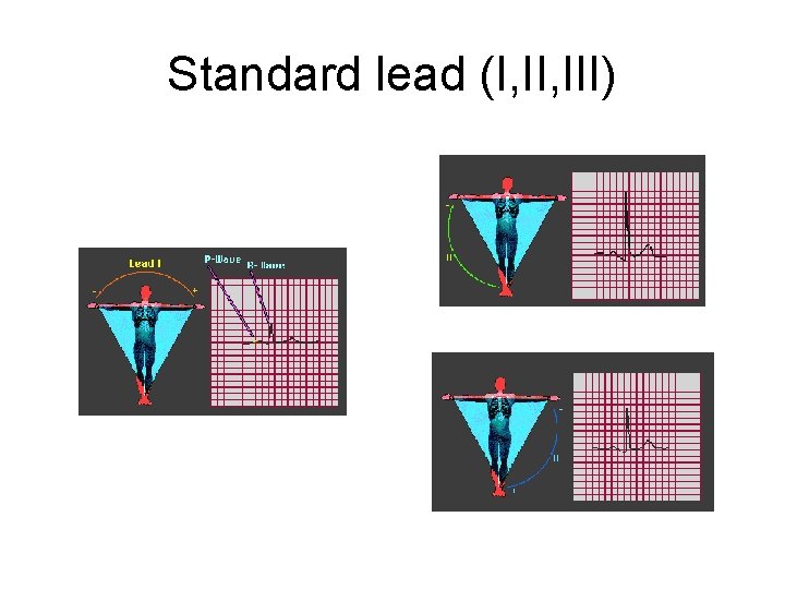 Standard lead (I, III) 