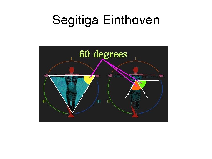 Segitiga Einthoven Segitiga Einthoven
