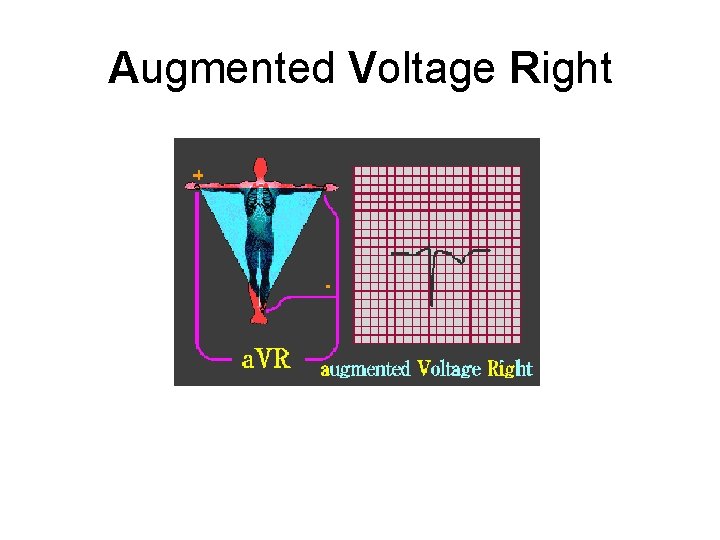 Augmented Voltage Right 