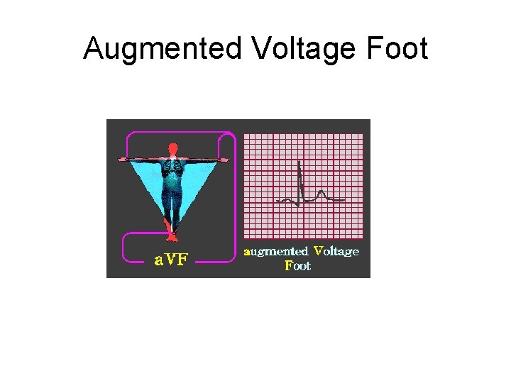 Augmented Voltage Foot 